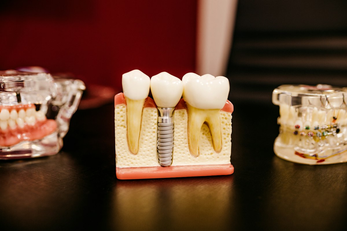 Implantes